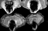 Hypertensive pontine hemorrhage